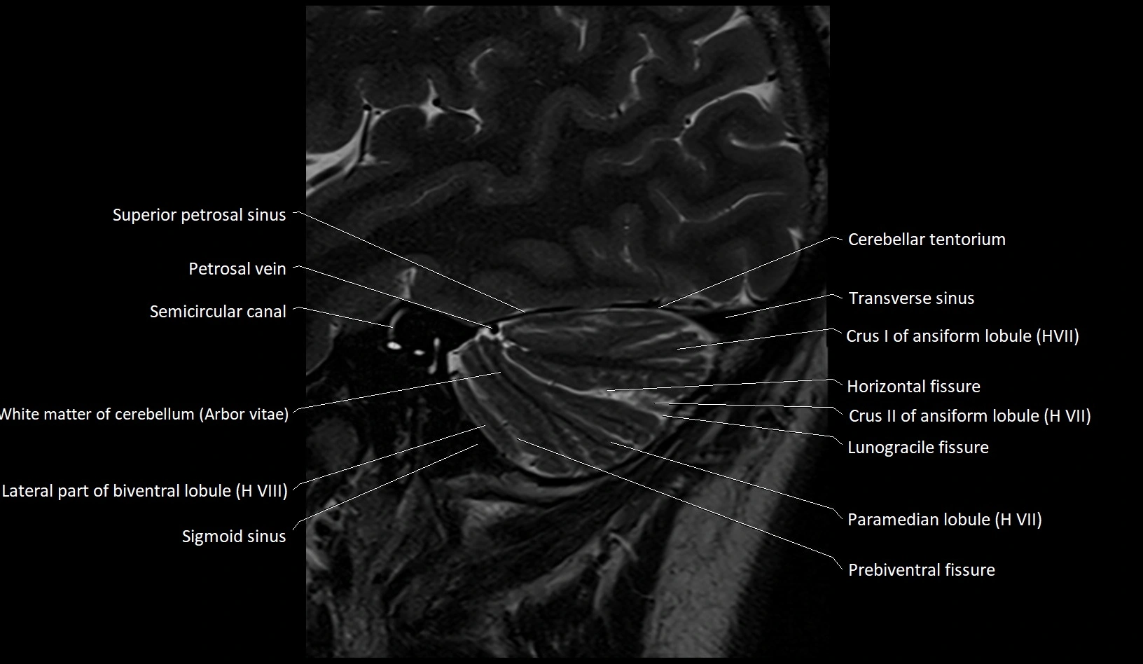 MRI Cerebellar anatomy sagittal High-resolution labelled image 8.webp
